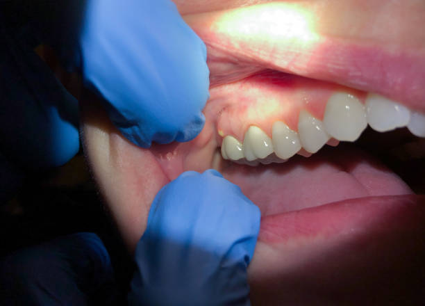 Best Emergency Treatment for Dental Infections or Abscesses in Heritage Village, CT