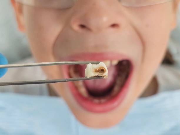 Best Emergency Tooth Extraction in Heritage Village, CT